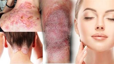 Certificate In Skin Disorders Alternative Therapy Treatment